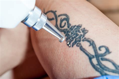There are some special temporary tattoo removal wipes available in the market. Can Tattoos Be Removed Completely? - Tattoo Removal Sydney ...