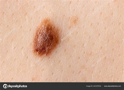 Mole Birthmark Nevus Macro Photo On Human Skin Close Up Stock Photo