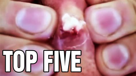 Pimple Popping Top Five Zit Methods Youtube