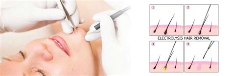 It has not been evaluated for. Electrolysis Philadelphia | Treatment for Hair Removal ...