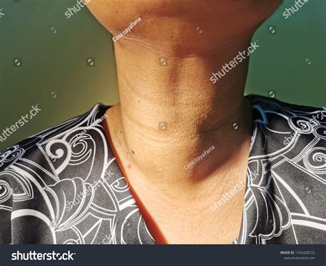 Anterior Neck Swelling Known Medically Goitre Stock Photo 1762428722