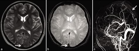 Pearls And Pitfalls In The Magnetic Resonance Diagnosis Of Dural Sinus