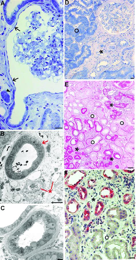 Tubular Changes Tubular Atrophy And Interstitial Fibrosis A The