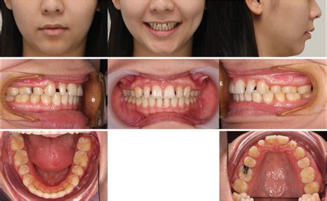 Interdisciplinary Management Of An Orthodontic Patient With