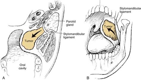 Benign Neoplasms Of The Salivary Glands Ento Key