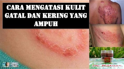 Cara Mengatasi Kulit Gatal Dan Kering Yang Ampuh Penyakit Kulit Kaki