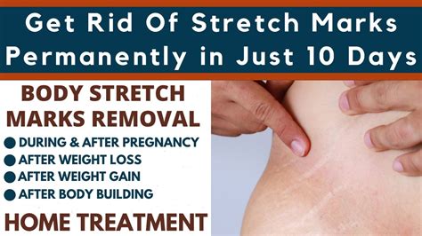 Stretch Marks Removal Home Remedies Permanently Resolve Stretch Marks