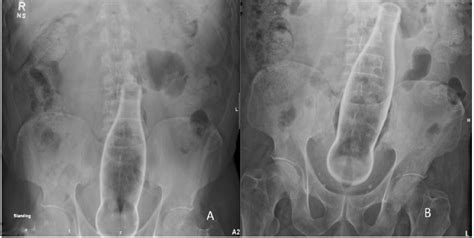 Retained Colorectal Foreign Body A Case Report