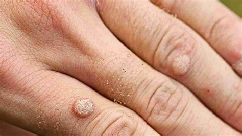 Skin Cancer Or Benign Wart How To Identify Cancerous Warts
