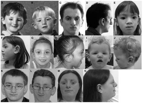 Figure 1 Craniofacial Phenotype In Individuals With