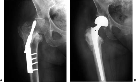 Hip Arthroplasty For Intertrochanteric Hip Fractures Teachme Orthopedics