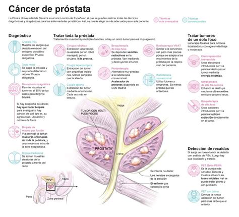 C Ncer De Pr Stata S Ntomas Causas Y Tratamiento Cancer Center Cl Nica Universidad De Navarra