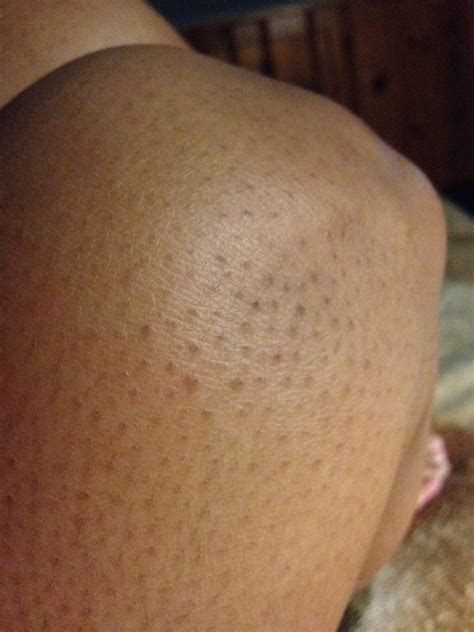 Bumps On Legs That Itch Needsmine
