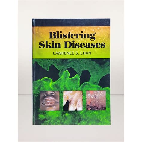 Blistering Skin Diseases Hardcover By Lawrence S Chan Shopee