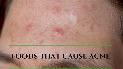 Foods That Cause Acnepimple Avoid These Foods For Clear Skin