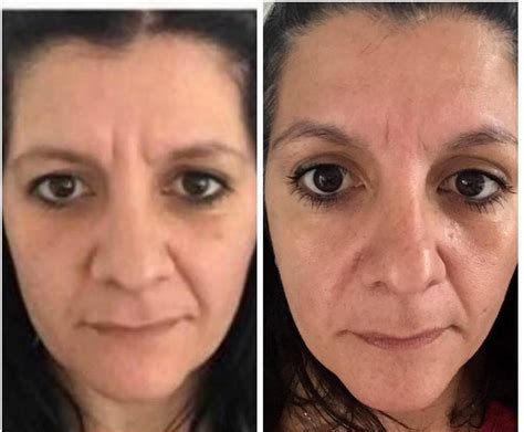 Botox And 11 Lines Before And After Facial Injections Info Prices