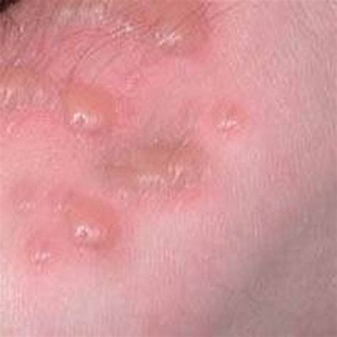 Common Skin Rashes Healthfully
