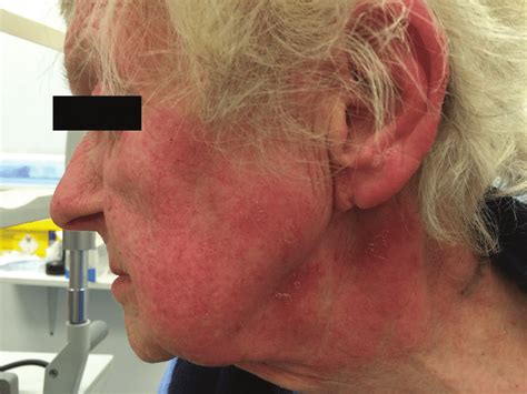 Blistering Rash On Face And Neck Download Scientific Diagram