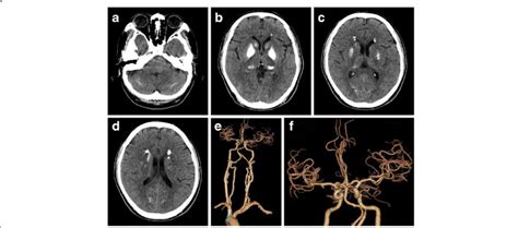 Computed Tomography Ct And Ct Angiography Cta A D Symmetric