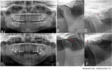 Temporomandibular And Odontological Abnormalities In Patients With