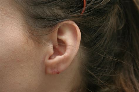 Earlobe Repair Archives Skin And Laser Surgery Center Of New England