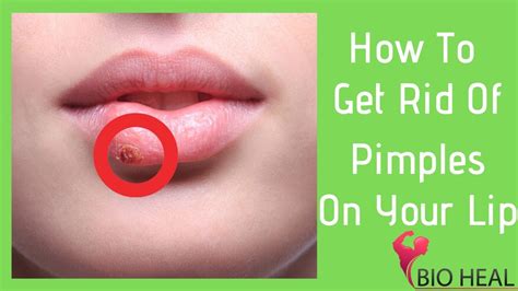 How To Get Rid Of Pimples On Your Lip 101 The Essential Guide Youtube
