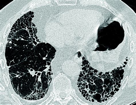 Idiopathic Pulmonary Fibrosis A Clinical Update British Journal Of