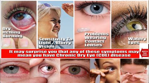 Dry Eye Syndrome Patient Education And Information Causes Symptoms Treatment Youtube