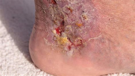 6 Things That Increase Your Risk Of Cellulitis