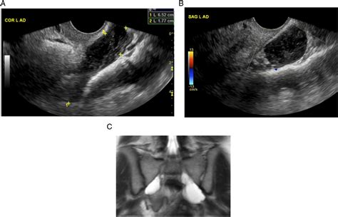 The Ovarian Adnexal Reporting And Data System For Ultrasound From