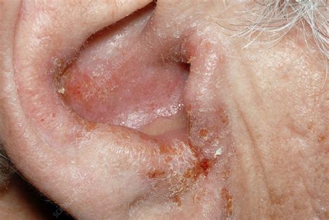 Outer Ear Infection Stock Image M1570089 Science Photo Library