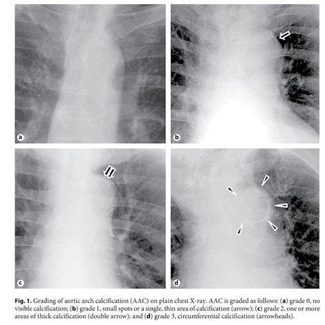 Assessment Of Aortic Arch Calcification Using Chest X Ray Aortic Arch