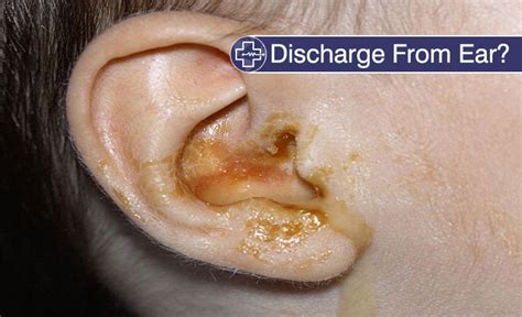 Discharge From Ear Causes Symptoms Diagnosis Home Remedies