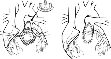 Timing And Technique Of Pulmonary Valve Replacement In The Patient With