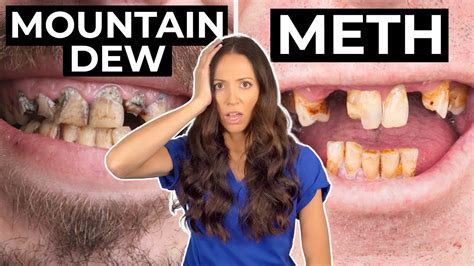 Meth Mouth Or Mountain Dew Mouth Which Is Worse Youtube
