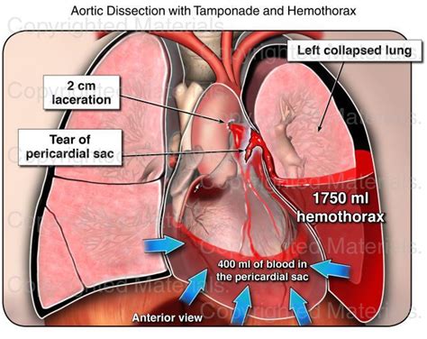 Aortic Dissection With Tamponade And Hemothorax Medical Exhibit