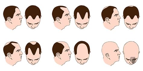 Horseshoe Pattern Baldness