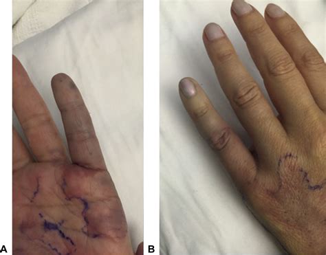 Acute Hand Ischemia Following Elective Venous Sclerotherapy For Dorsal
