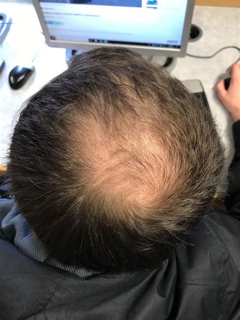 Balding hair is annoying and saddening, but in most cases, there is nothing you can do about it, and so the best thing is to work around it. Pattern hair loss - Wikipedia