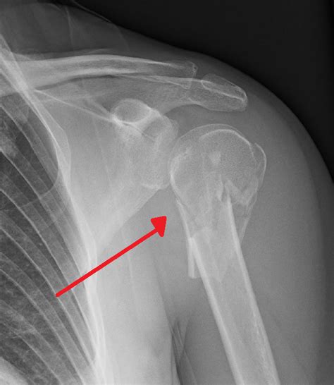 Proximal Humeral Fracture My Xxx Hot Girl