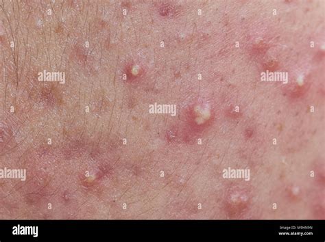 Papules Stock Photos And Papules Stock Images Alamy
