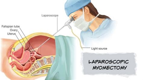 Laparoscopic Myomectomy Surgery Doctor In Dubai