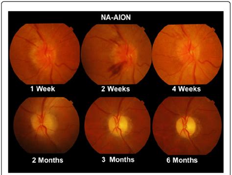 Progression Of Optic Nerve Changes In Na Aion From Initial Hyperaemia