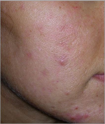 Acne In Women Ramos‐e‐silva 2015 British Journal Of Dermatology