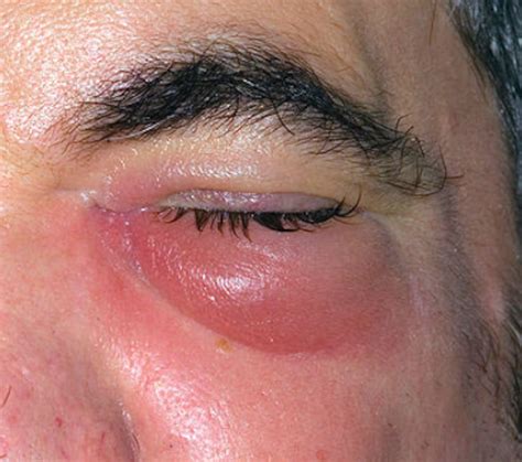 Does Periorbital Cellulitis Itch Maqsign