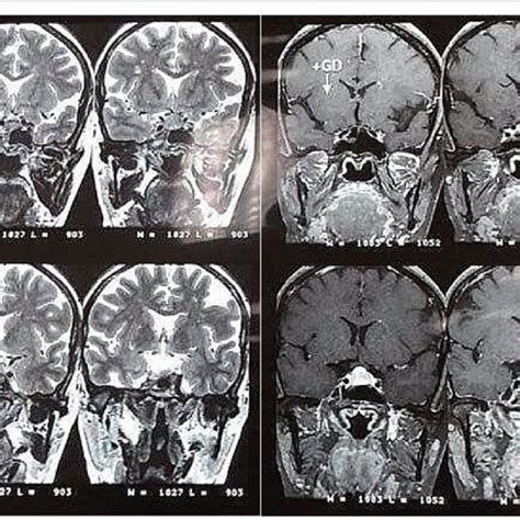 pituitary magnetic resonance imaging without and with gadolinium download scientific diagram