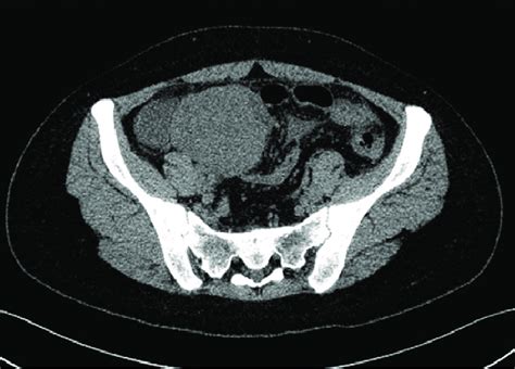 Ct Picture Showing A Large Well Defined Intra Abdominal Mass In The