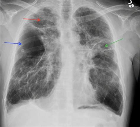 Pulmonary Fibrosis X Ray
