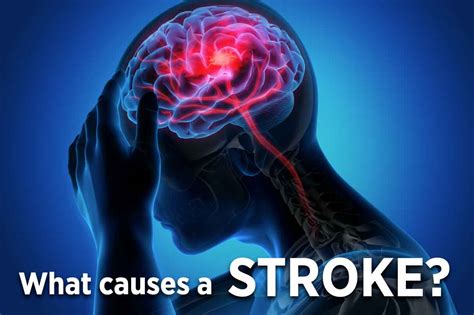 What Causes A Stroke Life Line Screening