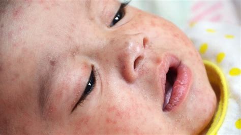 Measles Outbreak Declared In Philippines Bbc News